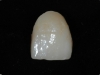 ceramica-integrale-di-silicato-di-litio-del-dente-21-prima