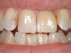 ceramica-integrale-di-silicato-di-litio-del-dente-21c