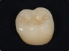 ceramica-integrale-in-disilicato-di-litio-del-dente-46-prima