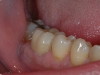 ceramica-integrale-in-disilicato-di-litio-del-dente-46