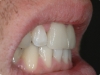 ceramiche-integrali-in-disilicato-di-litio-dei-denti-11-21-dx
