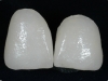 ceramiche-integrali-in-disilicato-di-litio-dei-denti-11-21-prima