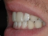 ceramiche-integrali-in-disilicato-di-litio-dei-denti-11-21-sx