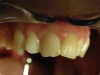 faccetta-in-disilicato-di-litio-del-dente-21b