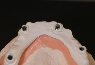 Estetica dentale in BioHPP