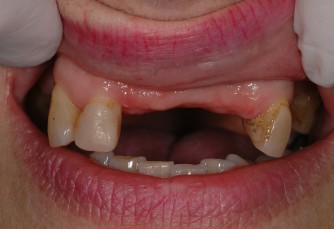 Dispositivi in Metallo-Nylon