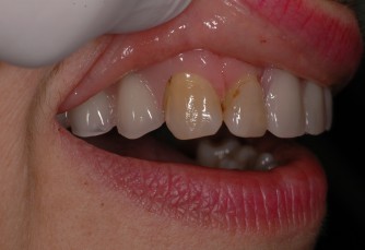 Dispositivi in Metallo-Nylon