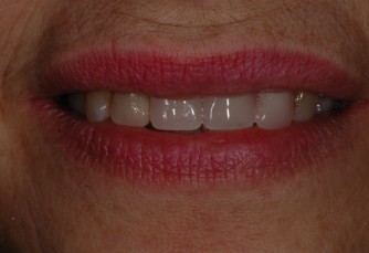 Dispositivi in Metallo-Nylon