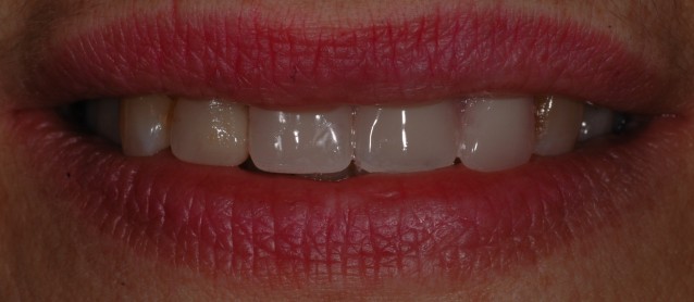 Dispositivi in Metallo-Nylon